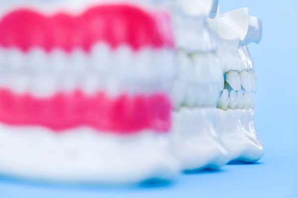 Is There A Recovery Period After Getting Dental Crowns?