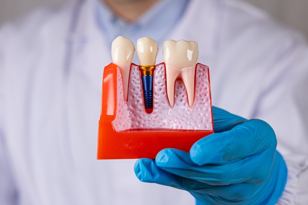 The Dental Implant Restoration Procedure