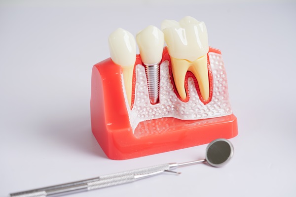 Implant Crowns: A Natural Looking Dental Restoration